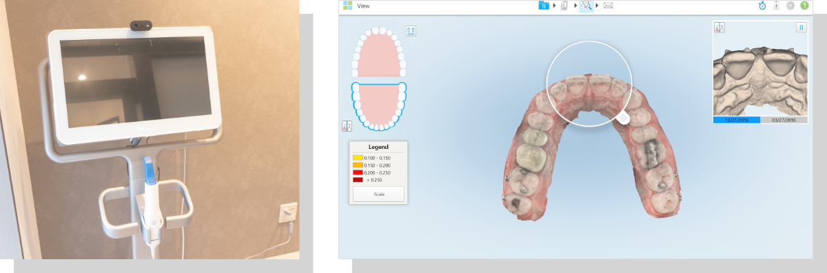 3Ｄスキャナーを用いた矯正治療