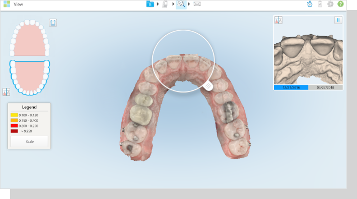 3Ｄスキャナーを用いた矯正治療